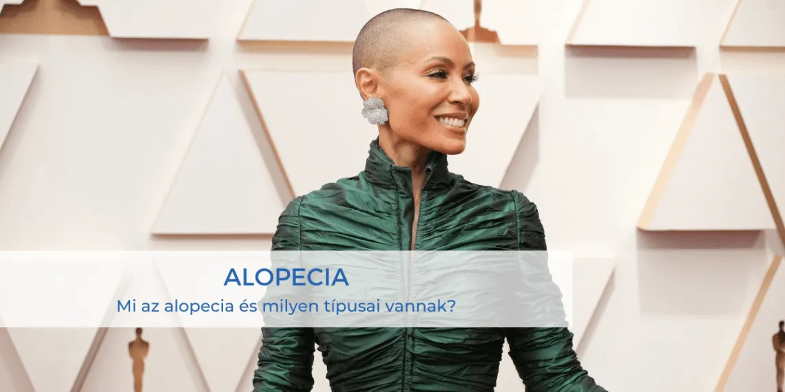 Mi az alopecia és milyen típusai vannak?